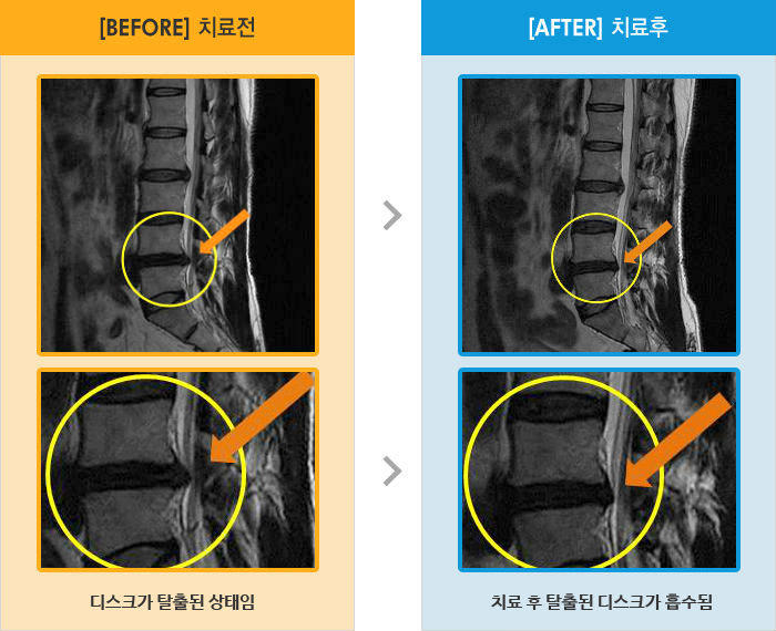 자생한방병원 치료사례 MRI로 보는 치료결과-허리 아래 통증과 우측 종아리 통증