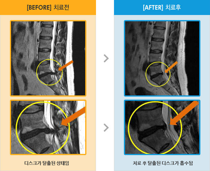 자생한방병원 치료사례 MRI로 보는 치료결과-요통과 우측 엉치 통증 및 감각저하