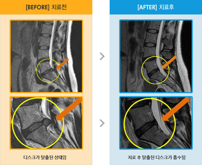 자생한방병원 치료사례 MRI로 보는 치료결과-허리와 좌측 다리 통증 및 저림으로 야간통과 기상통