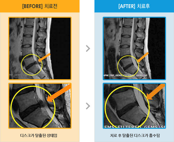 자생한방병원 치료사례 MRI로 보는 치료결과-허리와 골반 통증