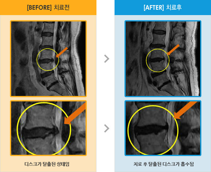자생한방병원 치료사례 MRI로 보는 치료결과-허리 양쪽다리 저림, 야간통