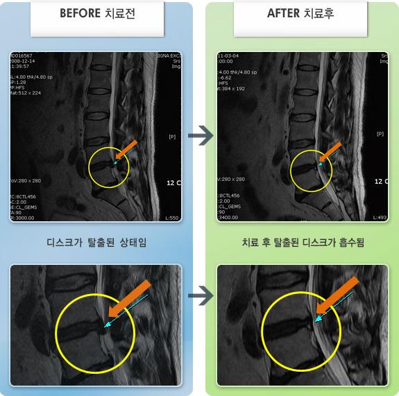 자생한방병원 치료사례 MRI로 보는 치료결과-오른쪽 엉치와 종아리 저린 느낌과 통증