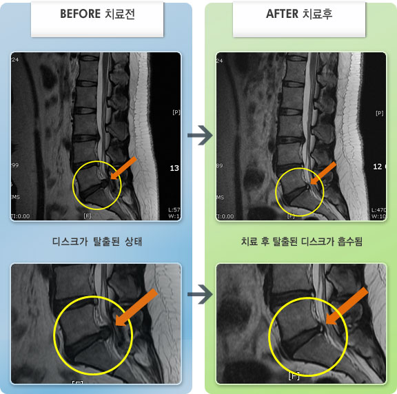 자생한방병원 치료사례 MRI로 보는 치료결과-처음 자생을 찾았을때 좌측 하지 방사통으로 인하여 보행이 힘들고, 모든 자세에서 통증이 심하였다.