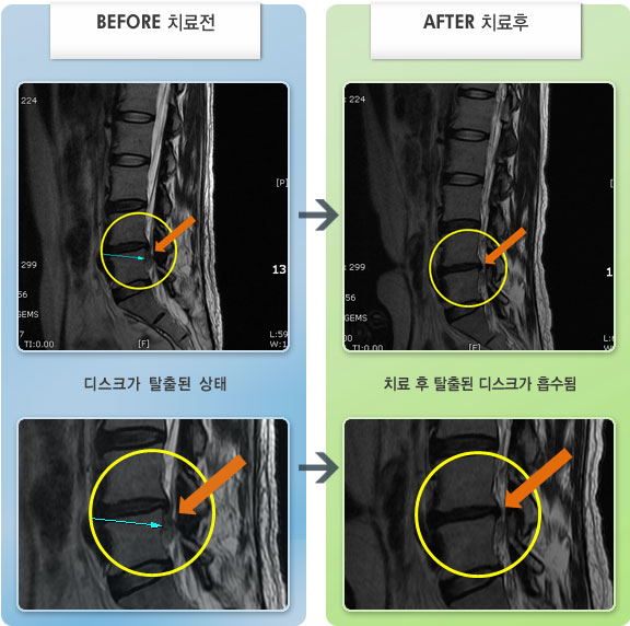 자생한방병원 치료사례 MRI로 보는 치료결과-오른쪽 허리 및 엉덩이 부위에 통증이 심하여 굽히거나 펴지 못하고 움직임이 자유롭지 못한 상태