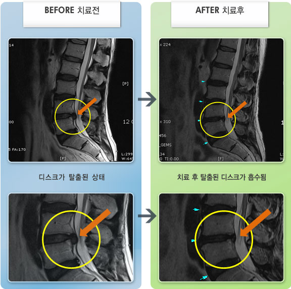 자생한방병원 치료사례 MRI로 보는 치료결과-심한 허리 통증으로 움직임이 자유롭지 못하여 지팡이를 짚고 보행하는 상태