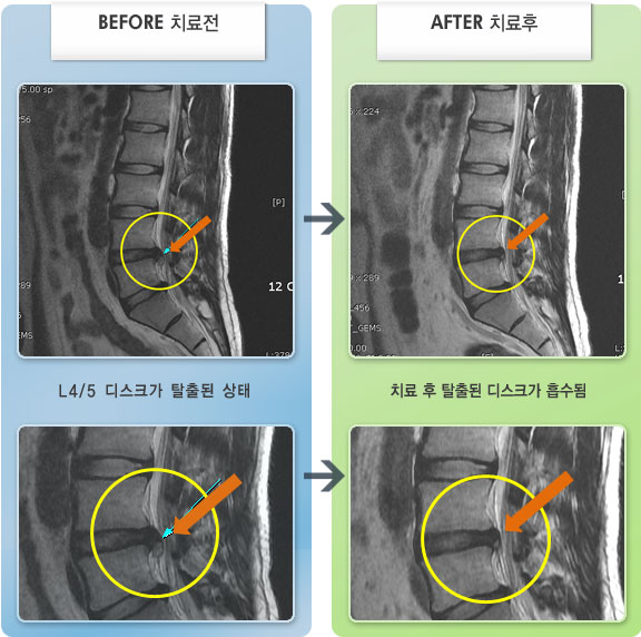 자생한방병원 치료사례 MRI로 보는 치료결과-허리 통증, 우측 다리 저린감과 감각 