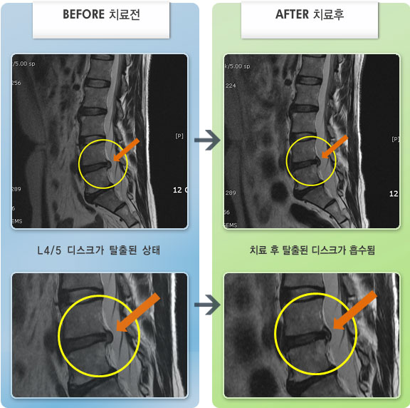 자생한방병원 치료사례 MRI로 보는 치료결과- 허리와 오른쪽 엉치 통증이 허리를 못 펼 정도로 심한 상태