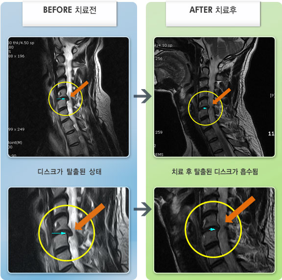 자생한방병원 치료사례 MRI로 보는 치료결과-견갑골 주위 통증 및 손에 간헐적 저림 증상