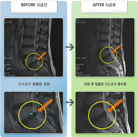 자생한방병원 치료사례 MRI로 보는 치료결과-허리 통증이 심하여 바로 눕기 힘들고 보행이 힘든상태. 간헐적으로 왼쪽 다리 통증