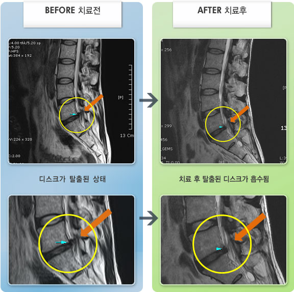 자생한방병원 치료사례 MRI로 보는 치료결과-좌측 대퇴부에서 발바닥까지 내려오는 저림 증상이 동반되었다.