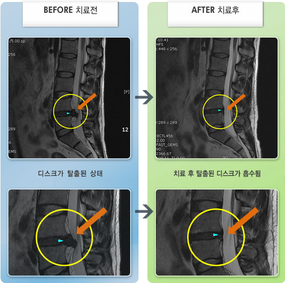 자생한방병원 치료사례 MRI로 보는 치료결과-우측 허리,엉치에서 다리 옆으로 당기고 저림