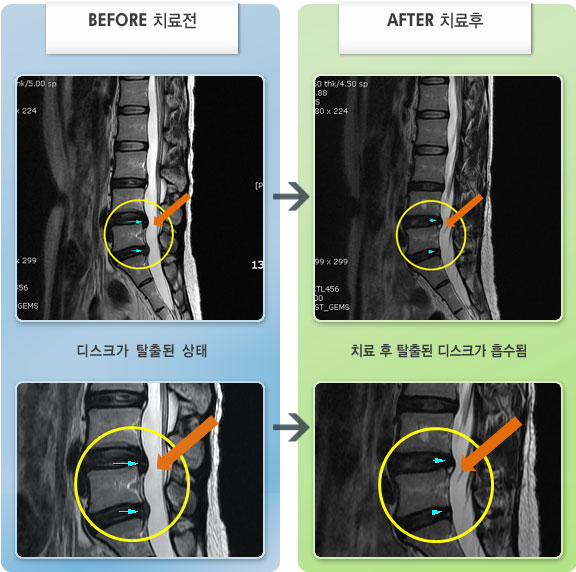 자생한방병원 치료사례 MRI로 보는 치료결과-허리와 양하지 통증 및 저림 등이 심하여 허리를 굽히거나 펴기 어려웠으며, 10분간 앉아있기도 힘든 상태