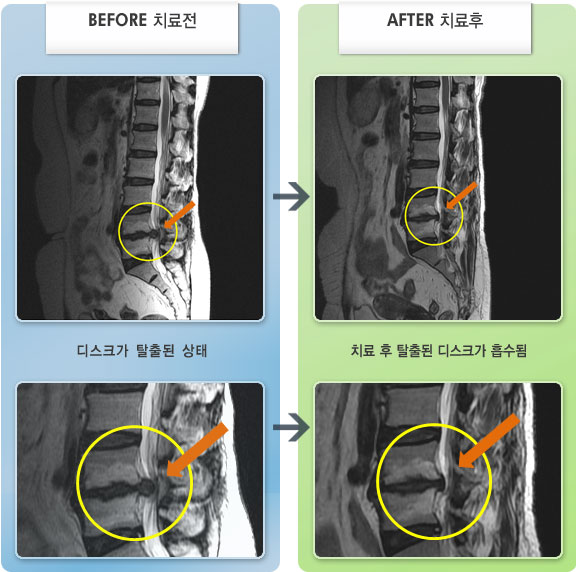자생한방병원 치료사례 MRI로 보는 치료결과-허리와 우측 다리의 심한 통증 및 감각 저하 증상으로 보행이 어려웠다.