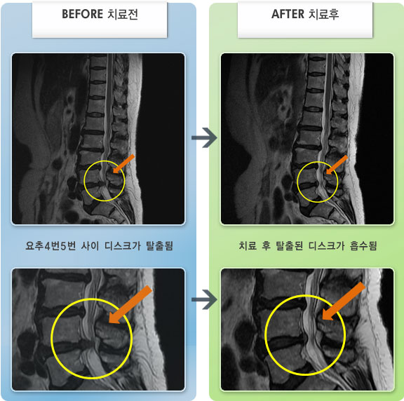 자생한방병원 치료사례 MRI로 보는 치료결과-허리 통증과 우측 허벅지에서 종아리로 심한 방산통때문에 보행이 힘들었다. 