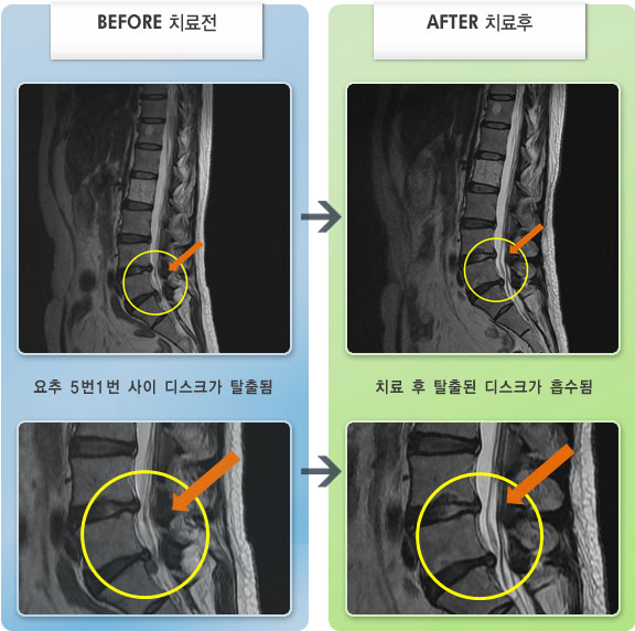자생한방병원 치료사례 MRI로 보는 치료결과-허리 통증과 양측 엉치 저림이 있었다.