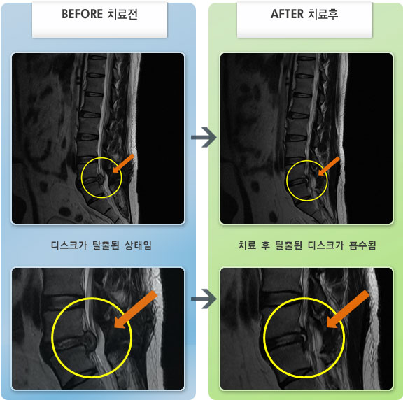 자생한방병원 치료사례 MRI로 보는 치료결과-내원당시 허리 통증과 오른쪽 다리 저림이 심했다.