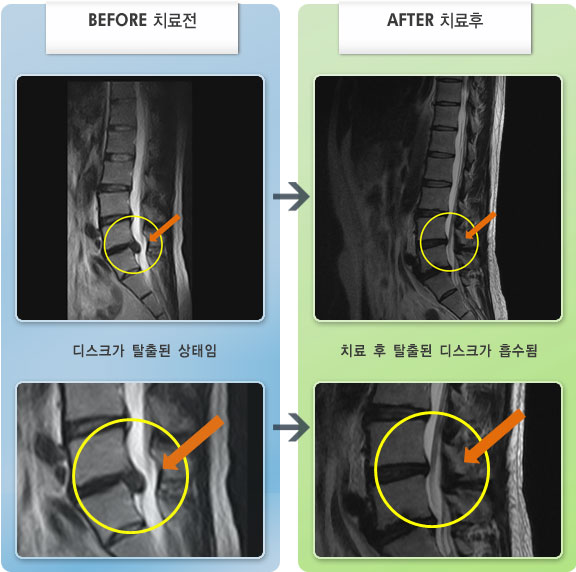 자생한방병원 치료사례 MRI로 보는 치료결과-허리디스크로 인한 좌측 허리 및 엉덩이 부위 통증