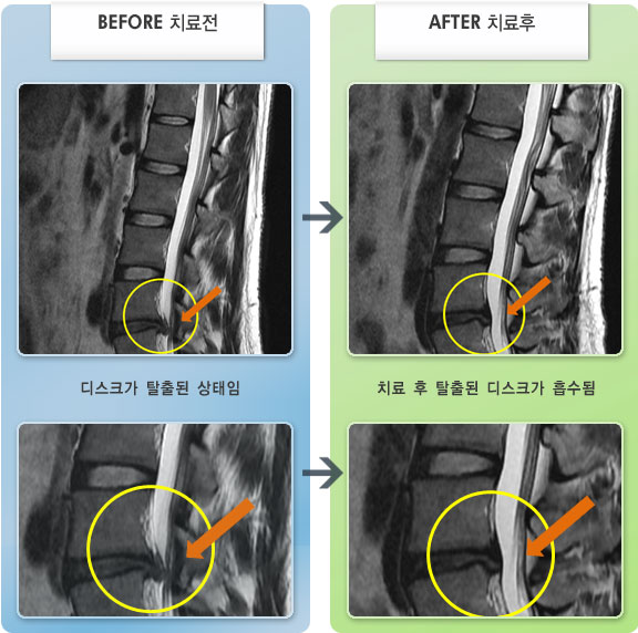자생한방병원 치료사례 MRI로 보는 치료결과-좌 둔부, 좌측 다리 저림 증상