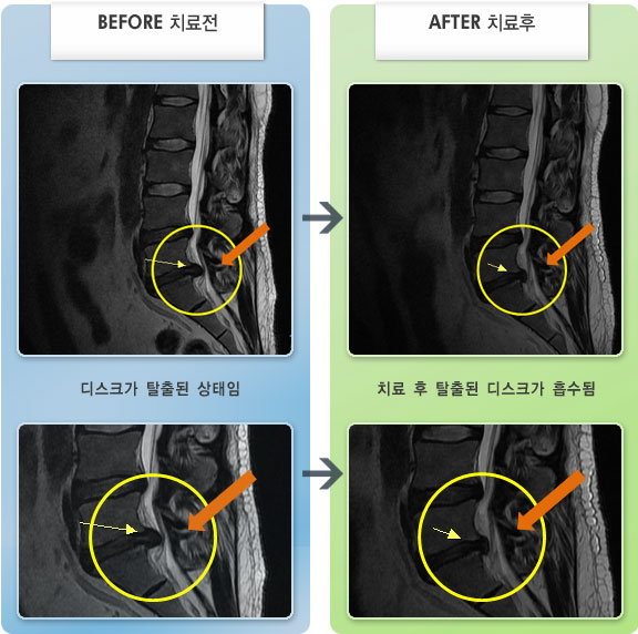 자생한방병원 치료사례 MRI로 보는 치료결과-허리디스크로 인한 종아리 통증
