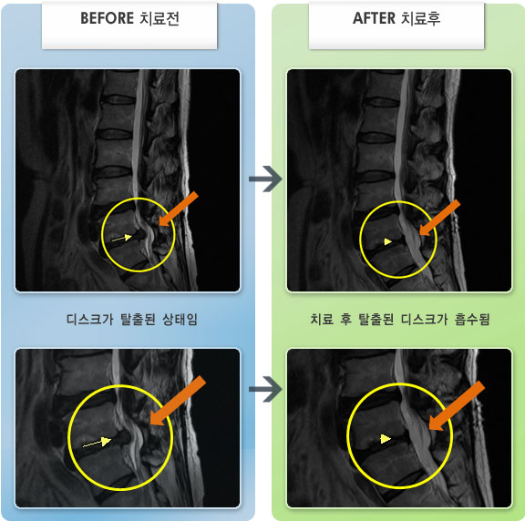 자생한방병원 치료사례 MRI로 보는 치료결과-수술하지 않고 치료하기위해 자생을 찾았다.