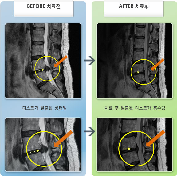 자생한방병원 치료사례 MRI로 보는 치료결과-허리디스크로 인한 허리 통증