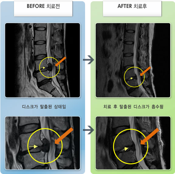 자생한방병원 치료사례 MRI로 보는 치료결과-허리디스크로 인한 허리통증 및 대퇴후면, 소퇴외측, 발목외측 저림 증상