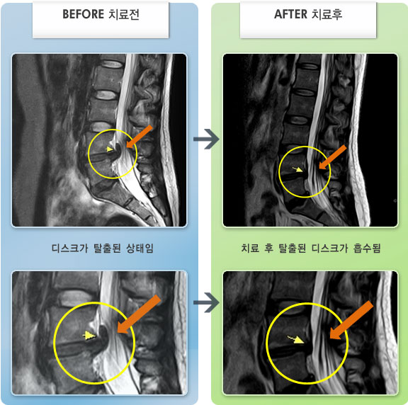 자생한방병원 치료사례 MRI로 보는 치료결과-허리 통증 및 좌측 허벅지, 종아리 감각 이상 증상