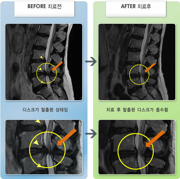 자생한방병원 치료사례 MRI로 보는 치료결과-허리디스크로 인한 허리와 우측 엉치 통증