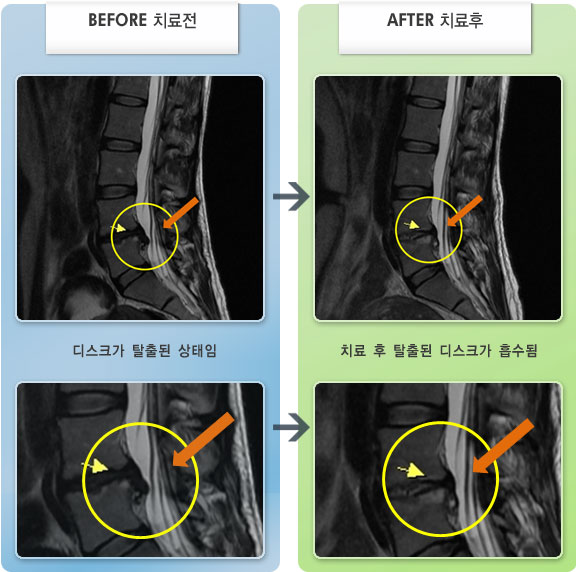 자생한방병원 치료사례 MRI로 보는 치료결과-허리디스크로 인한 보행시 허벅지, 발목 통증