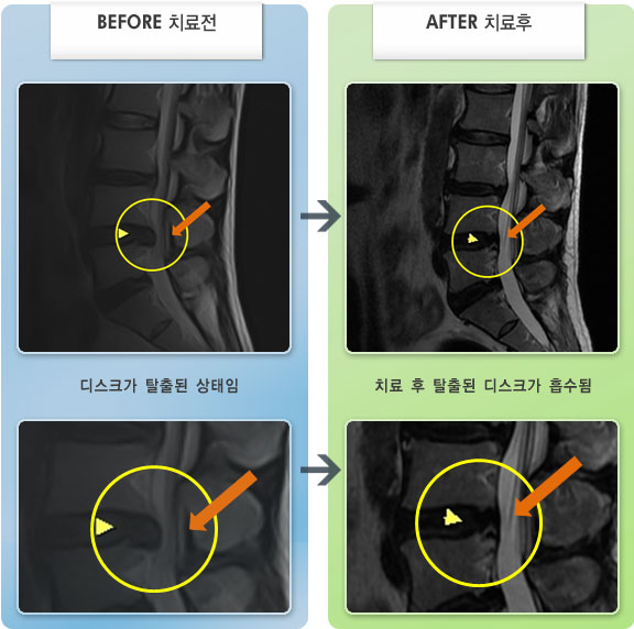 자생한방병원 치료사례 MRI로 보는 치료결과-허리디스크로 인한 허리 통증