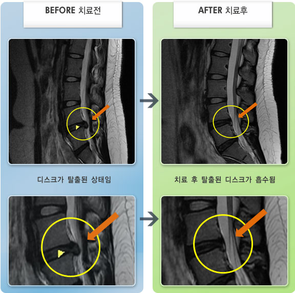 자생한방병원 치료사례 MRI로 보는 치료결과-오른쪽 골반 부위 통증