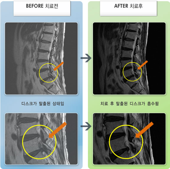 자생한방병원 치료사례 MRI로 보는 치료결과-오른쪽 발목, 발가락 배굴력이 저하되어 절룩이며 보행이 힘듬