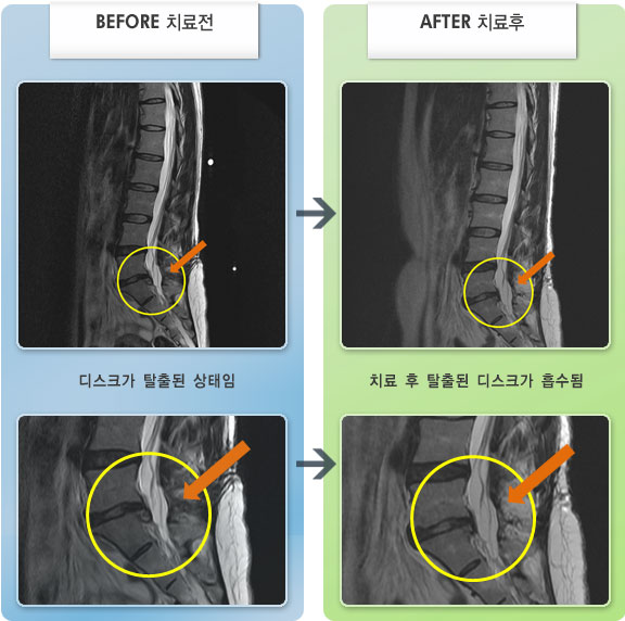 자생한방병원 치료사례 MRI로 보는 치료결과-허리디스크로 인한 오른쪽 골반의 불편감