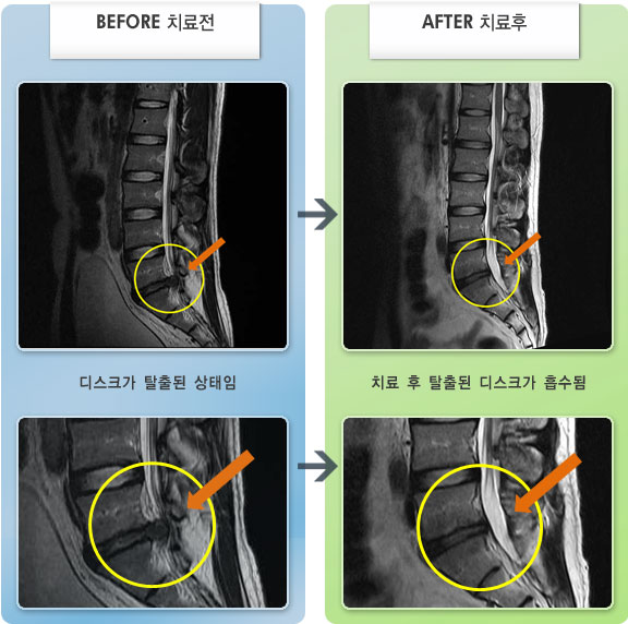 자생한방병원 치료사례 MRI로 보는 치료결과-허리 통증과 좌측 엉치, 대퇴, 소퇴, 새끼발가락 통증 및 저림