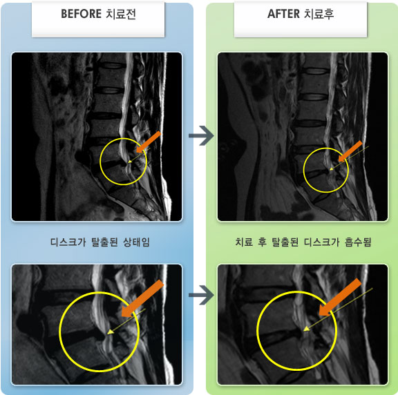 자생한방병원 치료사례 MRI로 보는 치료결과-허리 통증