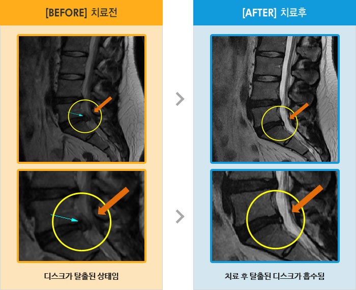 자생한방병원 치료사례 MRI로 보는 치료결과-허리와 오른쪽 다리 통증 및 저림