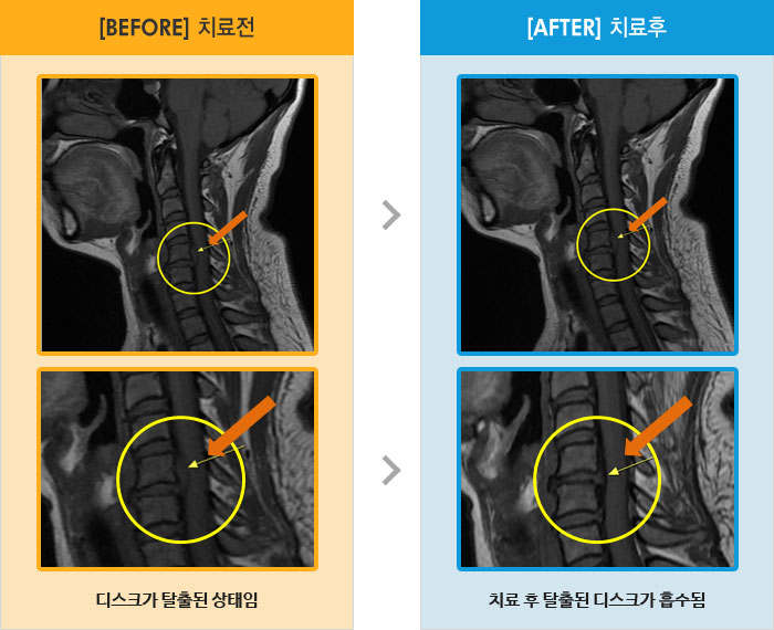 자생한방병원 치료사례 MRI로 보는 치료결과-목이 뻣뻣해서 움직이기 힘들고, 목 굽히거나 펴는 자세도 힘듬