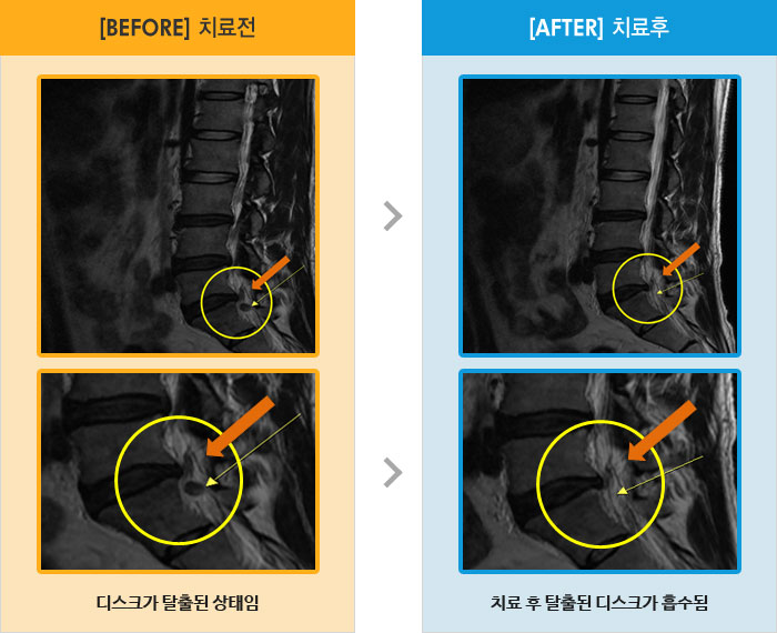 자생한방병원 치료사례 MRI로 보는 치료결과-허리 통증과 우측 허벅지 뒤로 저리고 당김이 심함