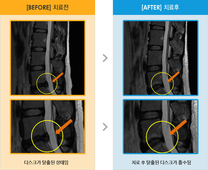 자생한방병원 치료사례 MRI로 보는 치료결과-양쪽 골반 및 허벅지 뒤쪽 통증