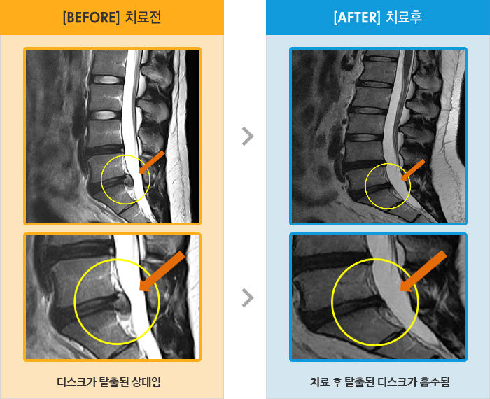 자생한방병원 치료사례 MRI로 보는 치료결과-허리 통증과 양쪽 허벅지 저림과 좌위에서 기립시 통증