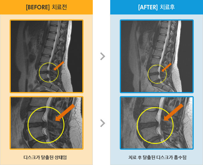 자생한방병원 치료사례 MRI로 보는 치료결과-허리, 엉치 통증 및 양쪽 다리 저림