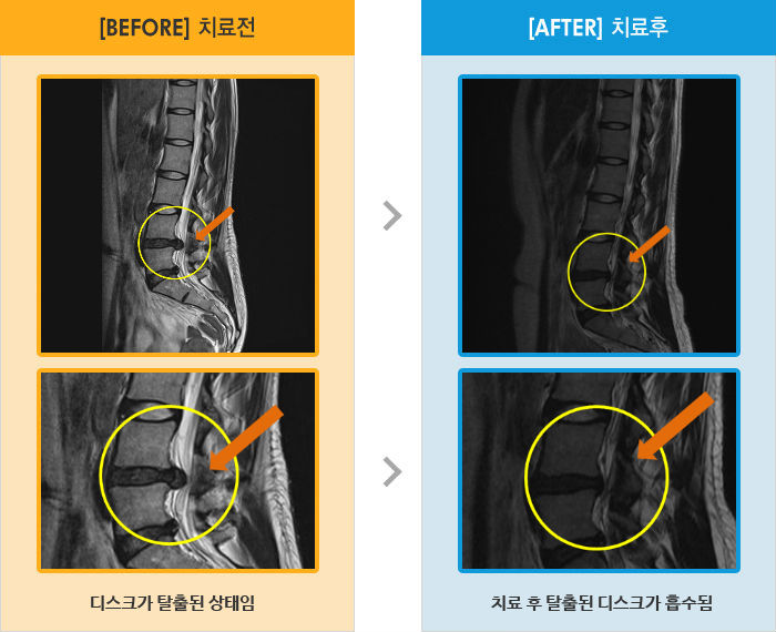 자생한방병원 치료사례 MRI로 보는 치료결과-허리 주위로 심한 통증과 좌측 엉치, 다리 저림