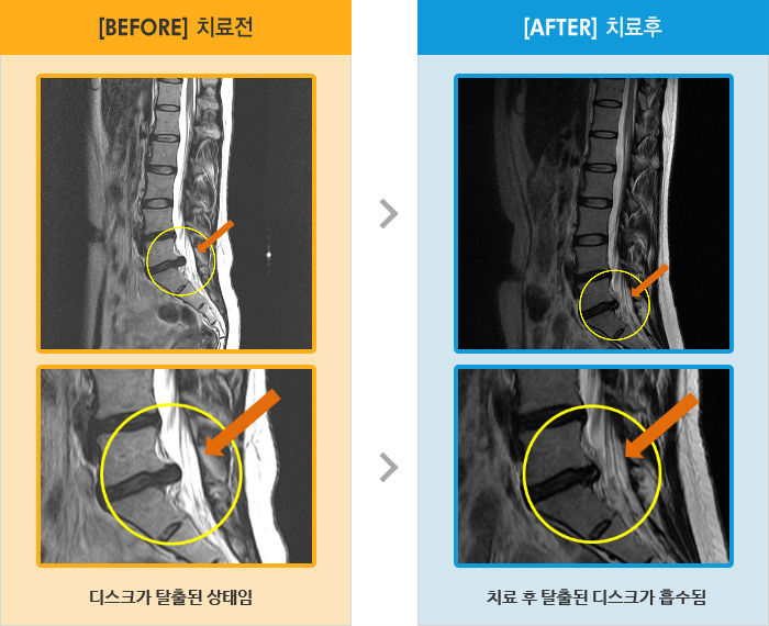 자생한방병원 치료사례 MRI로 보는 치료결과-오른쪽 엉치와 다리가 심하게 저림