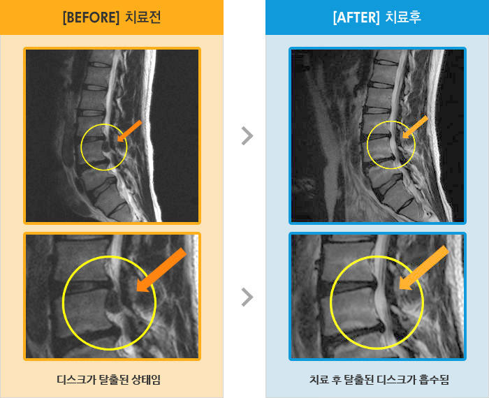 자생한방병원 치료사례 MRI로 보는 치료결과-좌측 요통과 좌측 하지 근력저하와 감각저하 증상