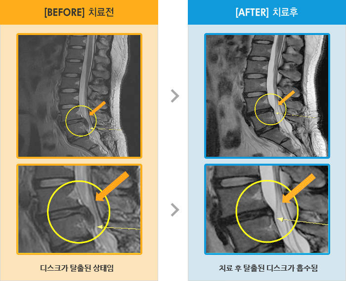 자생한방병원 치료사례 MRI로 보는 치료결과-양쪽 엉덩이에서 종아리까지 저리고 당김