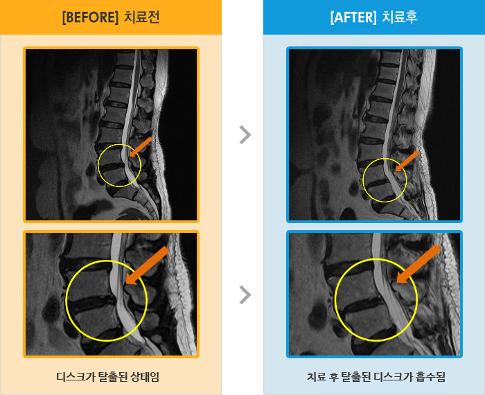 자생한방병원 치료사례 MRI로 보는 치료결과-바늘로 콕 찌르는 느낌으로 계단 보행이 어려움