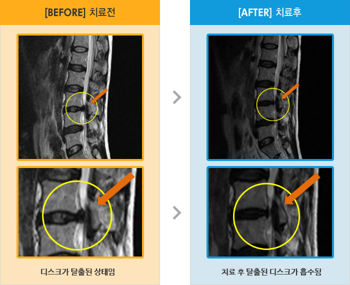 자생한방병원 치료사례 MRI로 보는 치료결과-허리 통증