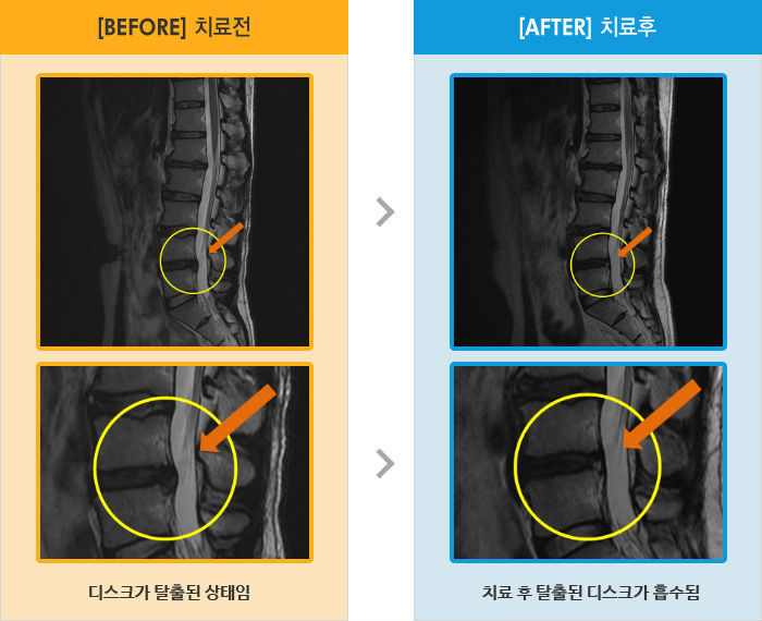 자생한방병원 치료사례 MRI로 보는 치료결과-허리 가운데로 통증
