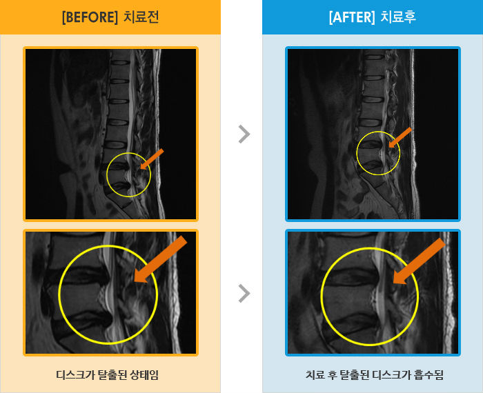 자생한방병원 치료사례 MRI로 보는 치료결과-허리와 오른쪽 다리 당김