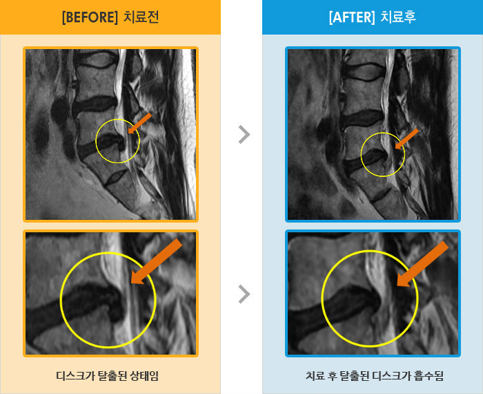 자생한방병원 치료사례 MRI로 보는 치료결과-오른쪽 허리 아래쪽으로 통증